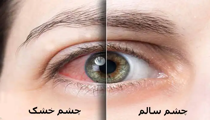 خشکی چشم